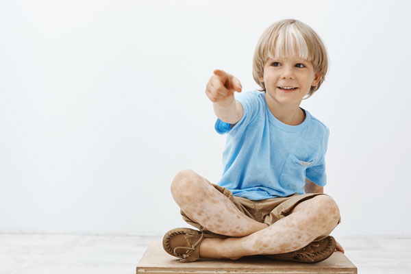 Enfant atteint de vitiligo Enfant atteint de vitiligo